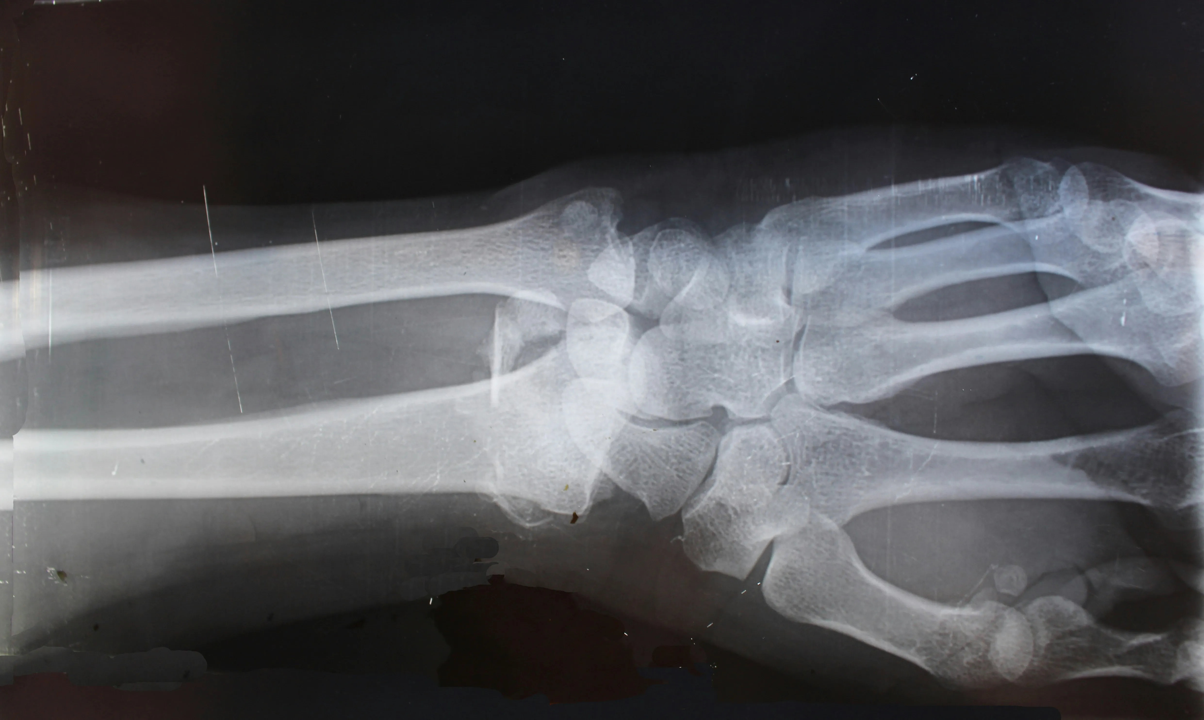 Detailed wrist X-ray showing bone structure